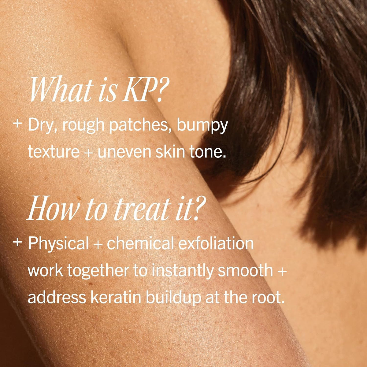 First Aid Beauty KP Bump Eraser Body Scrub, 10% AHA Body Exfoliator